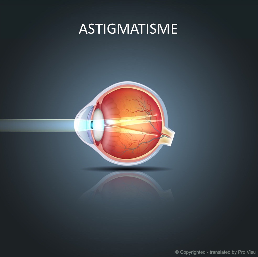 Astigmatism Contact Lens Malaysia